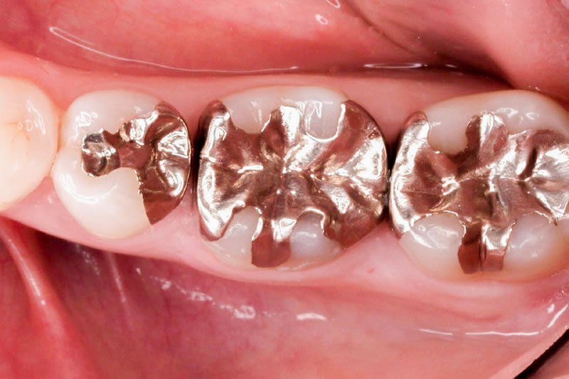 症例:治療前の歯