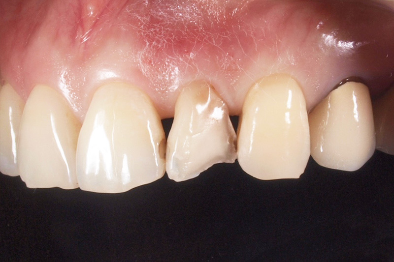 症例:歯の変色と欠けた状態