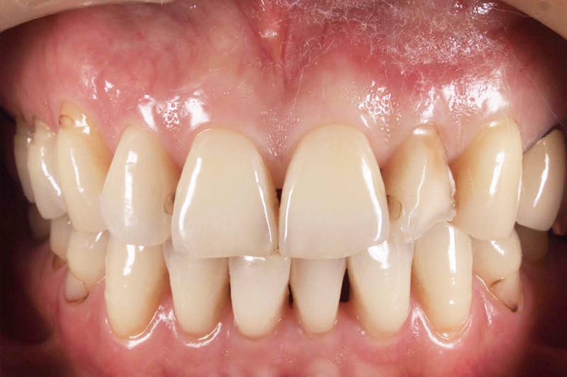 症例:治療前の歯の変色と欠けた状態