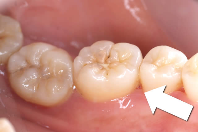 クリーニンク後の歯の様子