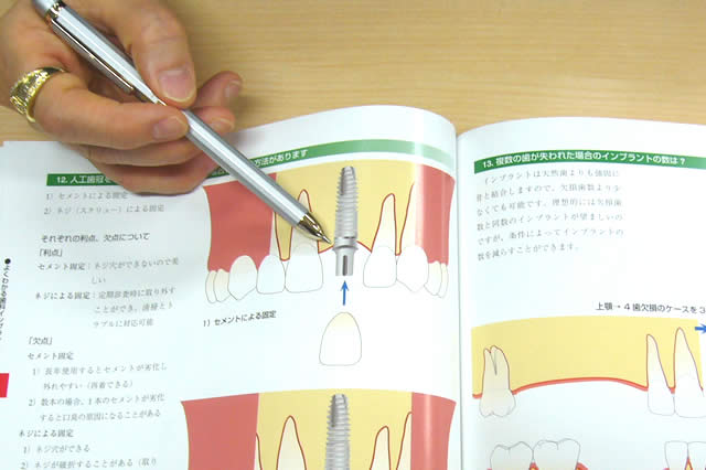 インプラント治療について